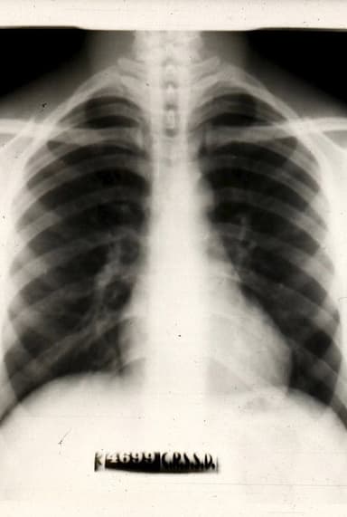 Peugeot pulmonaire poster