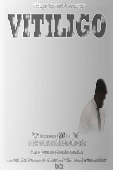Vitiligo poster