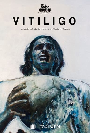 Vitiligo poster
