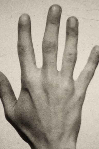 Fifth Metacarpal poster